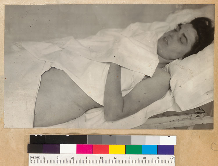 Morgue Photograph Of Virginia Rappe